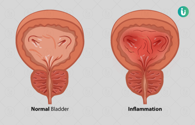 how-to-diagnose-and-treat-a-uti-health-life-and-recipes