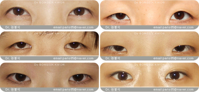 double eyelid surgery sg