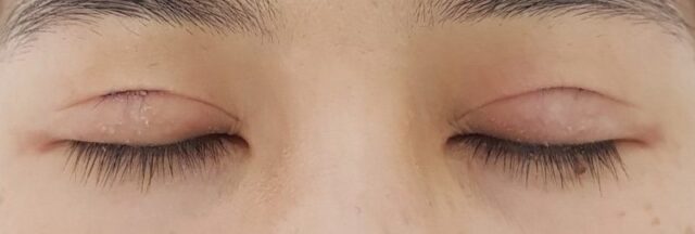 double eyelid surgery singapore blogger