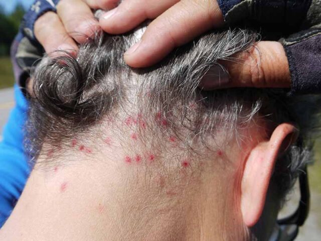 Some Lice Symptoms You Need to Be Aware Of - Health Life and Recipes