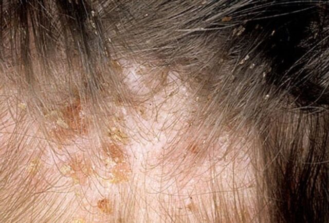 Some Lice Symptoms You Need to Be Aware Of - Health Life and Recipes