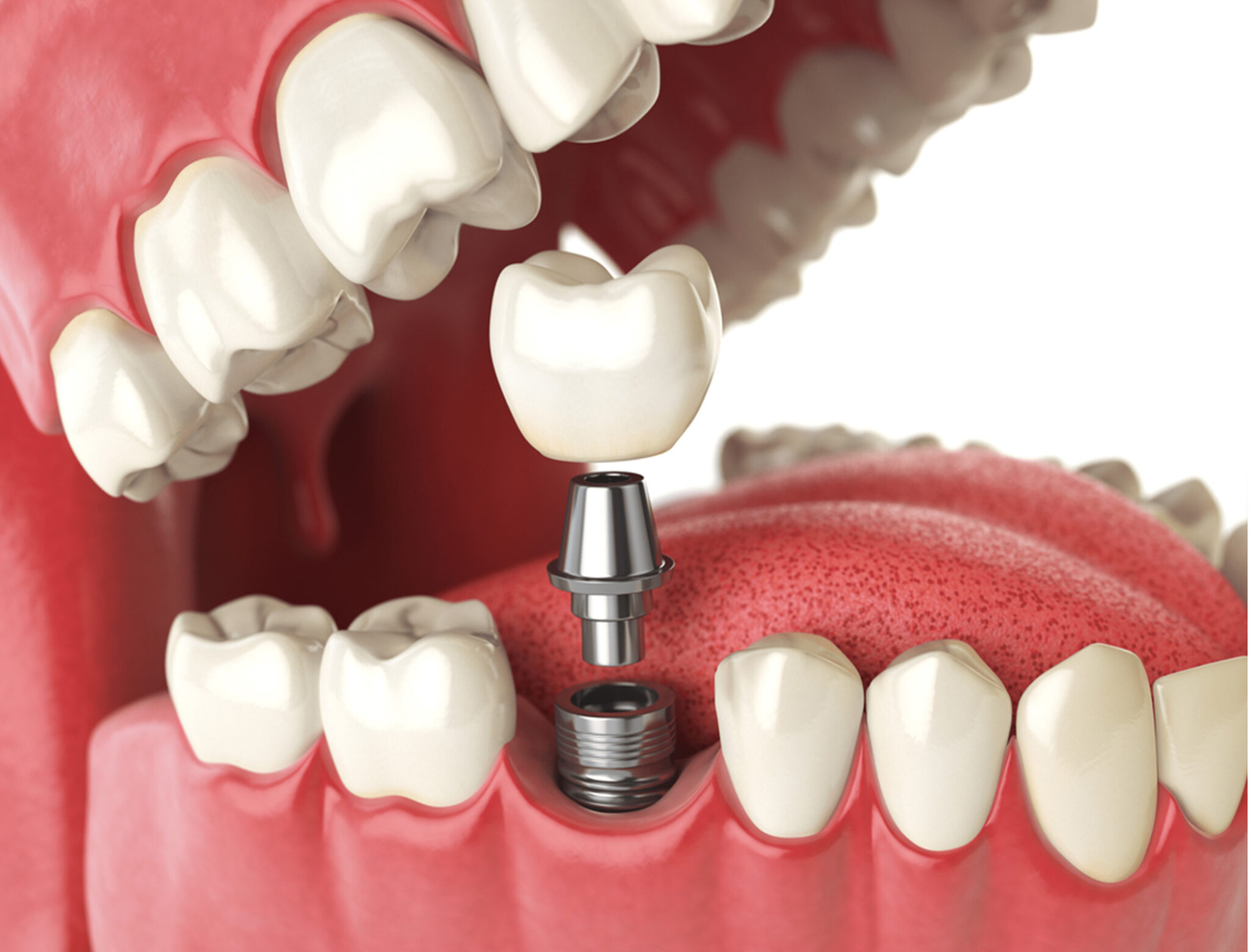 The Future of Dental Implants "What Are Potential Trends in the 2024s