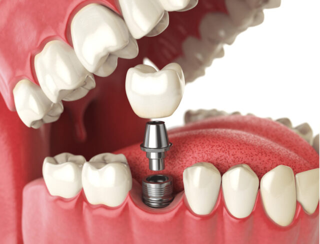 The Future of Dental Implants 