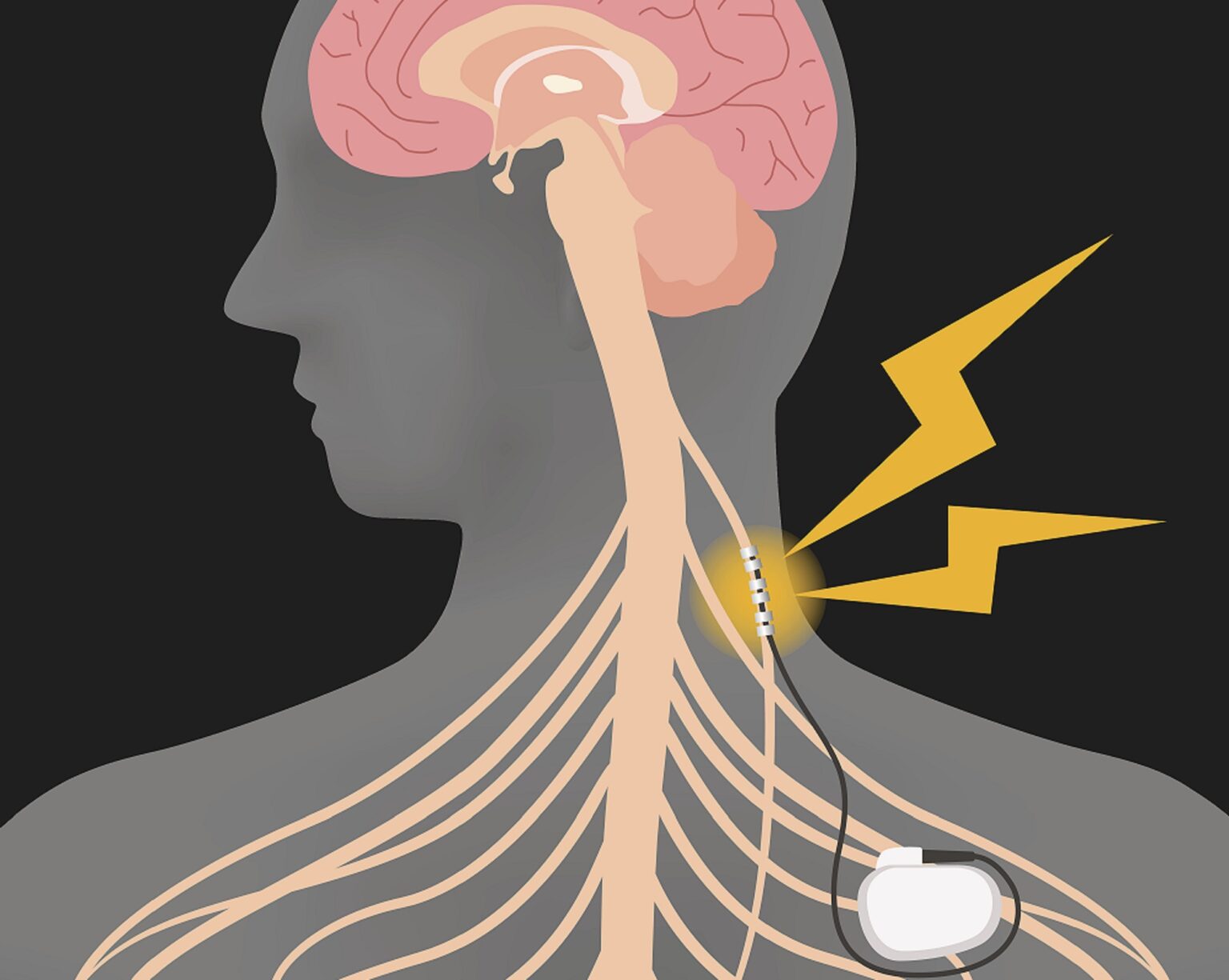 What Happens When The Vagus Nerve Is Triggered? - Health Life and Recipes