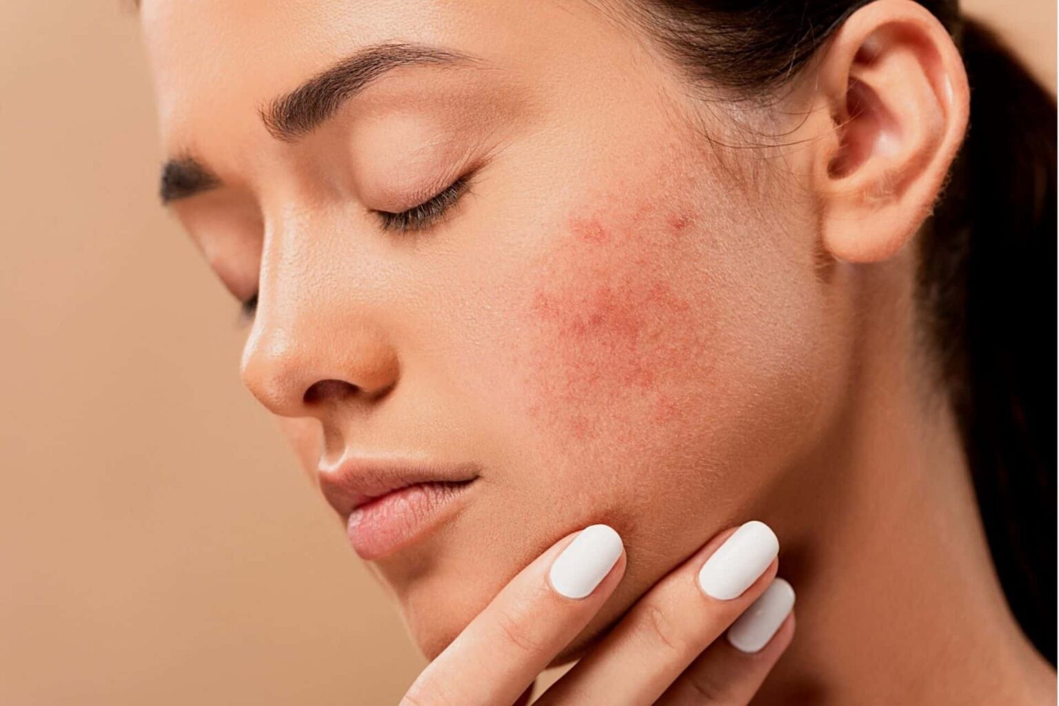 what-is-the-difference-between-bacterial-and-hormonal-acne-health