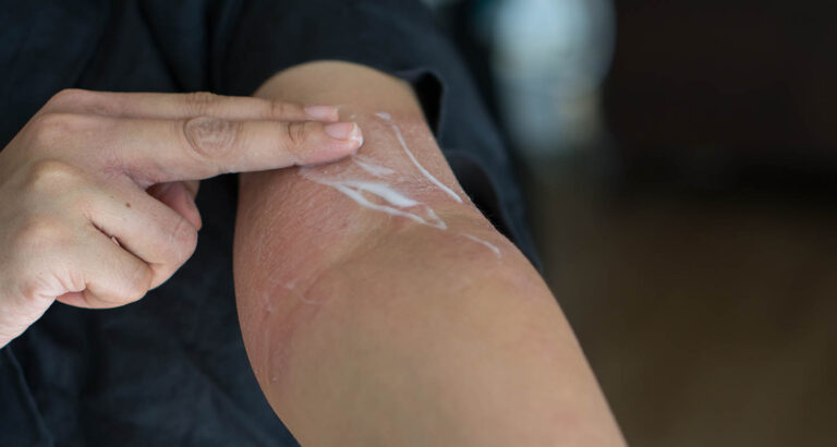 The Downside of Powerful Eczema Creams: Understanding the Risks and Side Effects