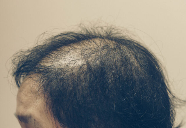 The Emergence of Permanent Hair Loss Injuries - Taxotere lawsuit